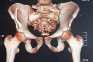 Ciclista atropelado fica 9 meses com peça de bicicleta na barriga