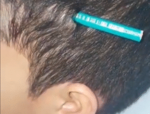 Aluno de 9 anos tem lápis cravado na cabeça por colega em escola municipal de Praia Grande